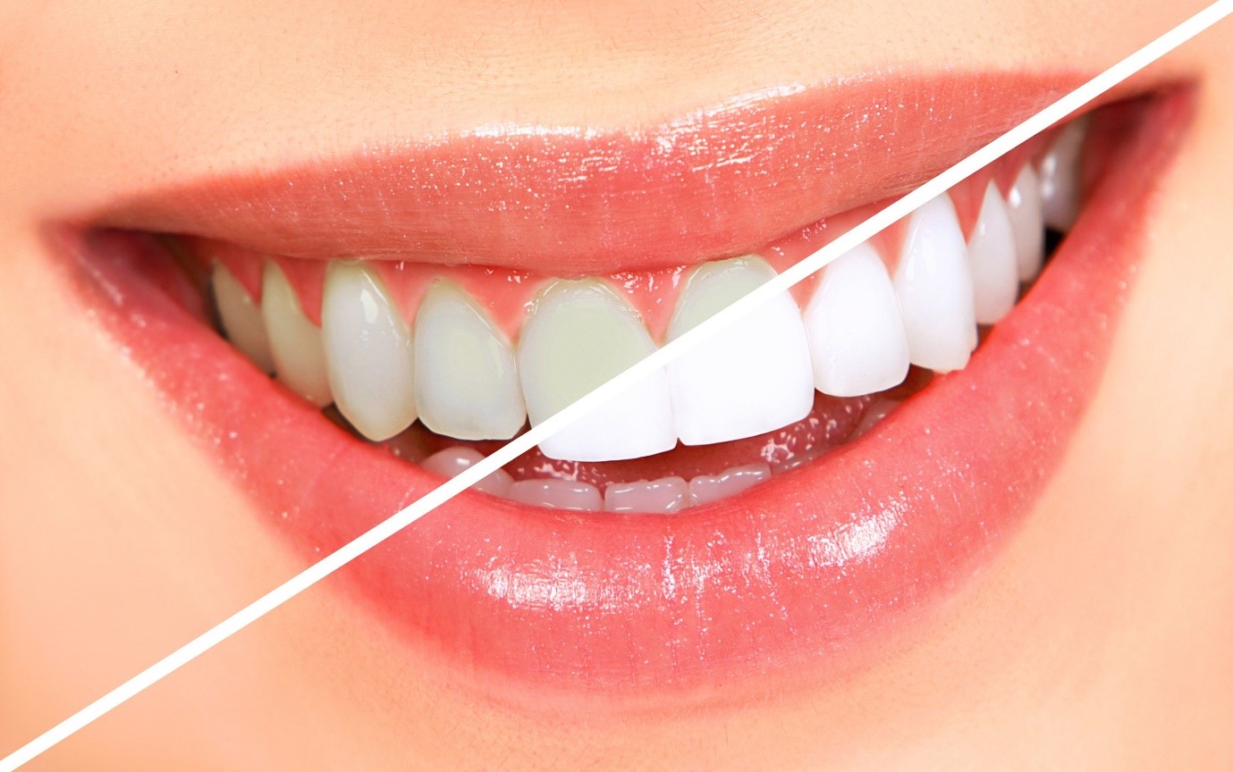 Is It Worth Getting Your Teeth Whitened At The Dentist?